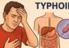 Šta je tifus i kako se manifestuje